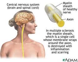 CCVI Liberation for Multiple Sclerosis